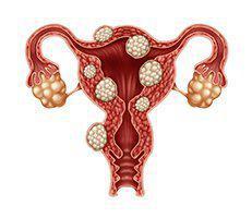 Fibroid Treatment